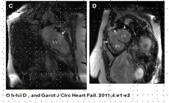 Radiation leads to microvascular insufficiency and ischemia,