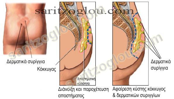 - μία ήπια ενόχληση και την εμφάνιση ενός μικρού ή μεγαλύτερου ''σπυριού'' από το οποίο, συνήθως εκρέει οροαιματηρό υγρό το οποίο λερώνει το εσώρουχο έως, - μια μεγάλη επώδυνη φλεγμονώδη μάζα και τον