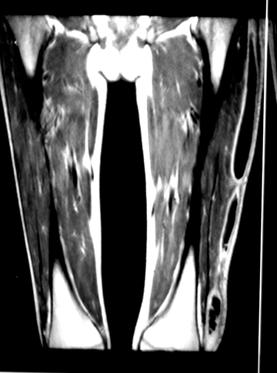 MRI λεκάνης ισχίων μηρών Αριστερός μηρός διογκωμένος σε όλη την έκτασή του με παρουσία εκτεταμένης αποστηματικής συλλογής που περιορίζεται στους υποδόριους ιστούς Ο δεξιός μηρός απεικονίζεται