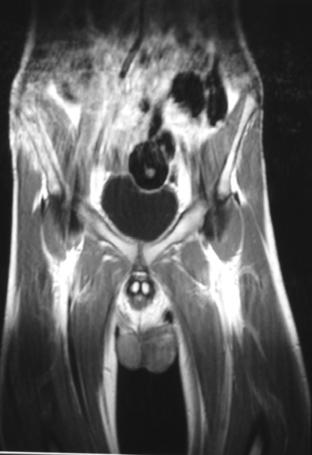 MRI λεκάνης- ισχίων- μηρών ` Εμμένουσα περιοστική αντίδραση (δε) λαγονίου οστούν Βελτίωση εικόνας (δε) λαγονίου μυ