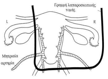 Λαπαροσκοπικά υποβοηθούμενη κολπική υστερεκτομία (LAVH) Υφολική