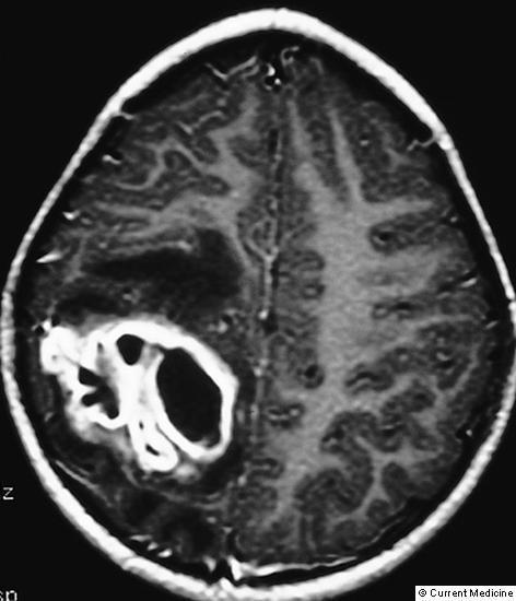 Διαγνωστική προσέγγιση εγκεφαλικού αποστήματος Νευρολογική εξέταση CT, MRI