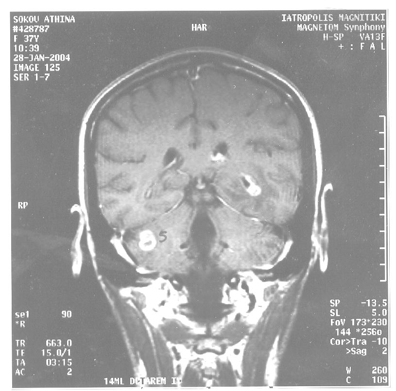 Η κλινική εικόνα ήταν συμβατή με μηνιγγοεγκεφαλίτιδα και το ΕΝΥ έδειξε: 5000/κκχ, Π: