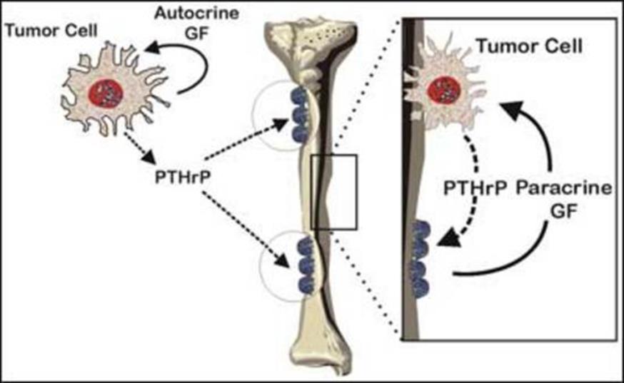 PTH-related protein (PTH-rp) Σύνδεση με τον υποδοχέα της ΡΤΗ (PTHR1) και ανάλογη δράση στα οστά Η PTHrp παράγεται σε μεγάλες ποσότητες σε κακοήθη νεοπλάσματα όπου προκαλεί υπερασβεσταιμία Η PTHrp