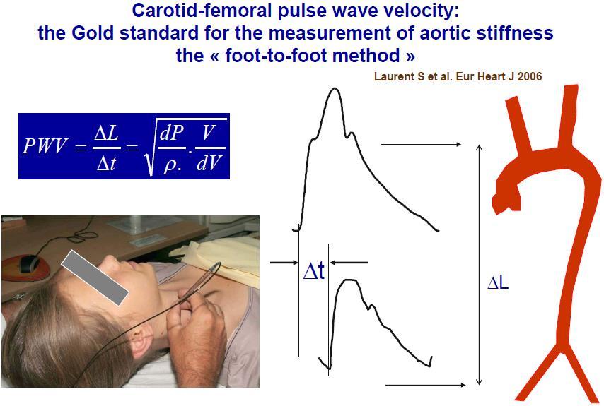 Carotid-Femoral PWV Inaccurate estimation of PWV can