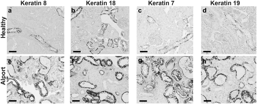 Ο ρόλος των Κερατινών και οι νεφρικές νόσοι Djudjaj S, Papasotiriou M et al. Kidney Int. 2016;89(4):792-808 v Οι κερατίνες σταθεροποιούν και προσδίδουν στα επιθηλιακά κύτταρα μηχανική αντοχή.