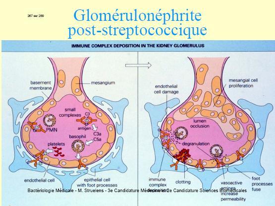 Sindromul şocului toxic streptococic, determinat de tulpini producătoare de toxină eritrogenă (febră, hipotensiune, erupţie generalizată, descuamare în convalescenţă, afectarea organelor).