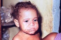 furuncule, carbuncule, abcese, hidrosadenite, mastită, panariţiu, infecţie de