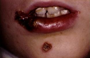 Exfoliatina determină epidermoliza buloasă (dermatita exfoliativă, sindromul