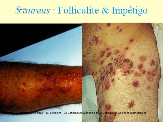 (boala Ritter) şi impetigo bulos la maturi.