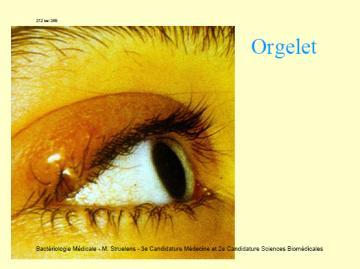 Infecţii viscerale: abces pulmonar, cerebral, flegmon perirenal, pielonefrite, etc