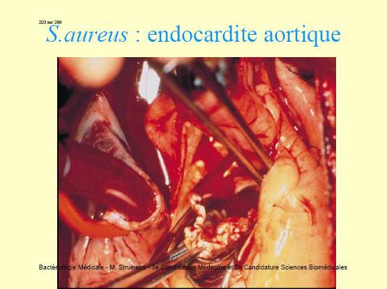 Septicemii şi endocardite. Cauzate şi întreţinute de un focar infecţios primar (infecţie cutanată, pneumonie, etc) complicat de tromboflebită.