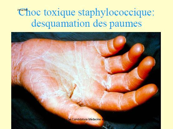 ..) Sindromul şocului toxic stafilococic: febră, hipotensiune arterială, erupţie scarlatiniformă în special pe palme şi plante, urmată de descuamare, stare de şoc, leziuni viscerale (cerebrale,