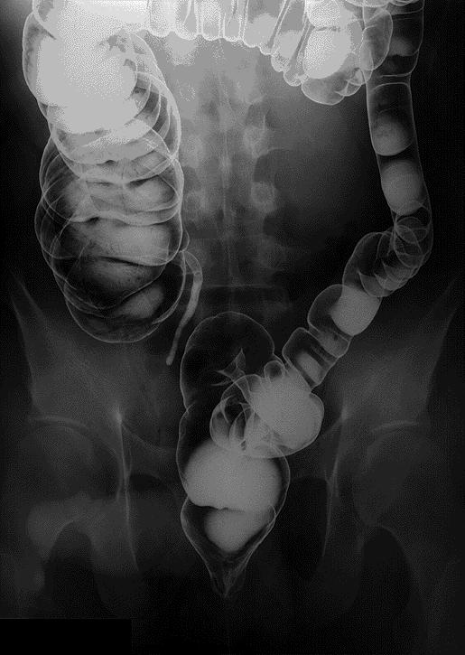 Εικόνα 13. Ακτινογραφική απεικόνιση του παχέος εντέρου με βαριούχο διάλυμα.
