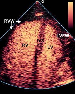 detect RV areas with decreased perfusion due to