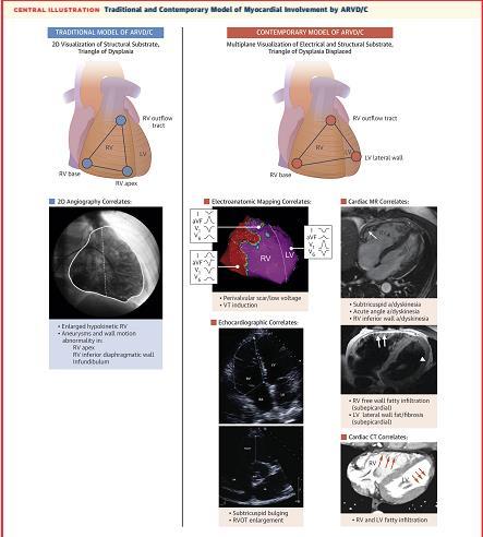 Contemporary 3-dimensional imaging and electroanatomic mapping frequently reveals biventricular involvement