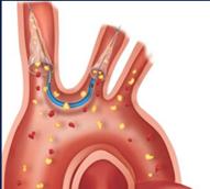 Delivery Sheath: 9F Access: Transfemoral Coverage: Brachiocephalic, left common carotid, left subclavian Pore Size: