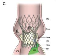 συχνότερες επιπλοκές της TAVI