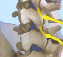 טיפול בתסמונות כאב פסטלי בגב גבי Thoracic( )Facet pain syndrome באמצעות גלי רדיו: עיקרון הטיפול בכאב פסטלי באמצעות גלי רדיו באזור גב גבי דומה לטיפולים בכאב פסטלי בגב תחתון ובצוואר.
