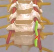 הטיפול בכאב בכתף באמצעות גלי רדיו מבוסס על השפעתם על העצב הסופראסקפולרי nerve(,)suprascapular הממוקם ב- notch Suprascapular )תמונה 18( ומעצבב פרק כתף עצמו וחלק גדול משרירי הכתף.