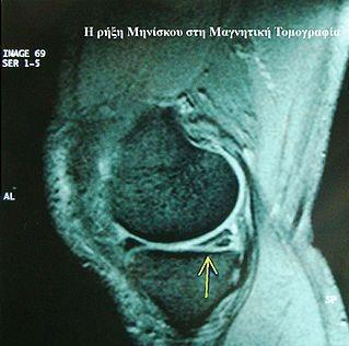 1.3.1 ΔΙΑΓΝΩΣΗ Στην διάγνωση των μηνίσκων και γενικά των ενδαρθρικών παθήσεων του γόνατος σημαντική είναι, ιδιαίτερα σε αμφίβολες περιπτώσεις, η βοήθεια που προσφέρουν ο ακτινολογικός έλεγχος, το