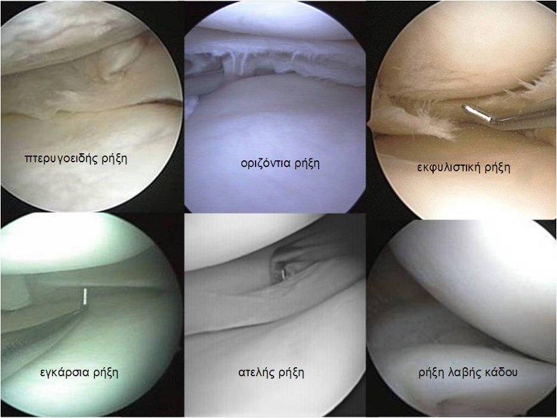 Εικόνα 16: Ρήξεις μηνίσκου αρθοσκοπικά 1.3.