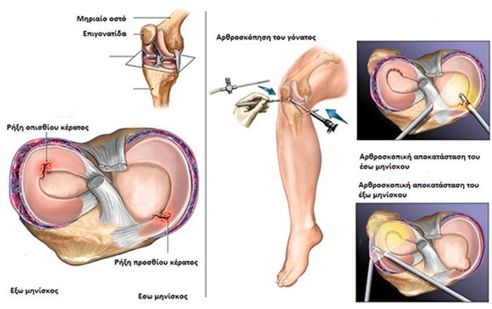 Εικόνα 17: Αρθροσκόπηση γόνατος για ρήξη μηνίσκου 1.4 ΦΥΣΙΚΟΘΕΡΑΠΕΥΤΙΚΗ ΑΝΤΙΜΕΤΩΠΙΣΗ Φυσικοθεραπευτική Αξιολόγηση Το ιστορικό και η φυσική εξέταση κατευθύνουν το φυσικοθεραπευτή στη μηνισκική κάκωση.