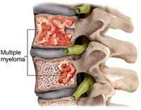 ΠΟΛΛΑΠΛΟΥΝ ΜΥΕΛΩΜΑ Οστικά άλγη Οστεολυτικές βλάβες-οστεοπενία-καταγματα Υπερασβεστιαιμία