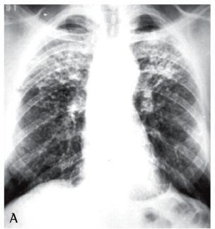 Α/α θώρακος συμβατή με παλαιά TB αγνώστου δραστηριότητας Σε παρουσία συμπτωμάτων,σκέψου ενεργό TB Στείλε 3 πτύελα για καλλιέργειες,μοριακό και ελεγχο ευαισθησίας (πρόκληση-βρογχοσκόπηση για