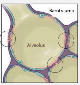 Strain=VT/FRC Stress