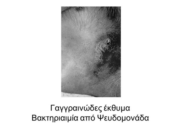 Ουδετεροπενία & λοιμώξεις Ειδικές κλινικές εικόνες Γαγγραινώδες έκθυμα Νεκρωτική εντεροκολίτιδα Ασπεργίλλωση πνεύμονα Διηθητική καντιντίαση ήπατος, σπληνός Λοιμώξεις δέρματος μαλακών μορίων σε