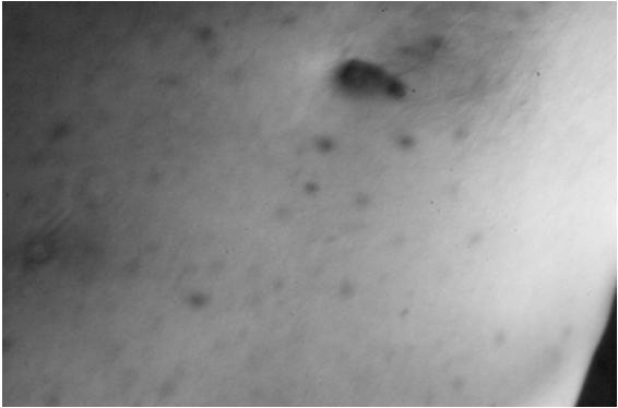 aureus Μικρές ερυθρές βλατιδώδεις διάσπαρτες