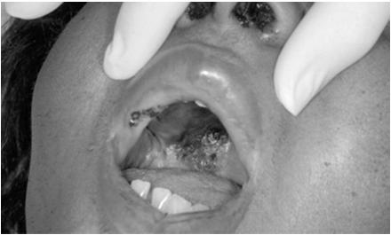 Εικόνα μουκορμύκωσης σε ουδετεροπενικό ασθενή Παράγοντες που συνδέονται με λοιμώξεις από υφομύκητες