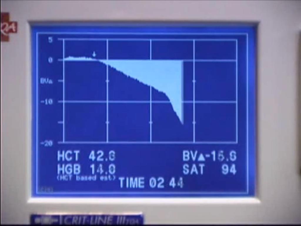 ΟΙΔΗΜΑ UF rate < Refill rate Δεν βγάζω αρκετά