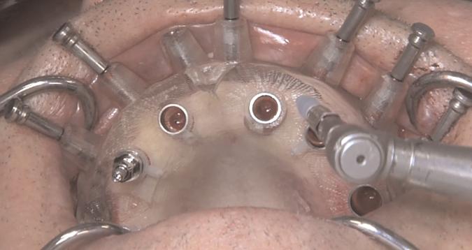 Χειρουργική τοποθέτηση οδοντικών εμφυτευμάτων με ή χωρίς αναπέταση κρημνού - Σύγκριση τεχνικών Εικόνα 1.