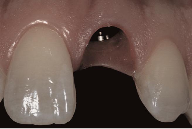 Χειρουργική τοποθέτηση οδοντικών εμφυτευμάτων με ή χωρίς αναπέταση κρημνού - Σύγκριση τεχνικών. 71 ΠΙΝΑΚΑΣ Ι Σύγκριση των δύο τεχνικών από άποψη πλεονεκτημάτων.