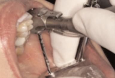 Χειρουργική τοποθέτηση οδοντικών εμφυτευμάτων με ή χωρίς αναπέταση κρημνού - Σύγκριση τεχνικών. 73 που συνυπάρχουν αισθητικοί λόγοι 12.