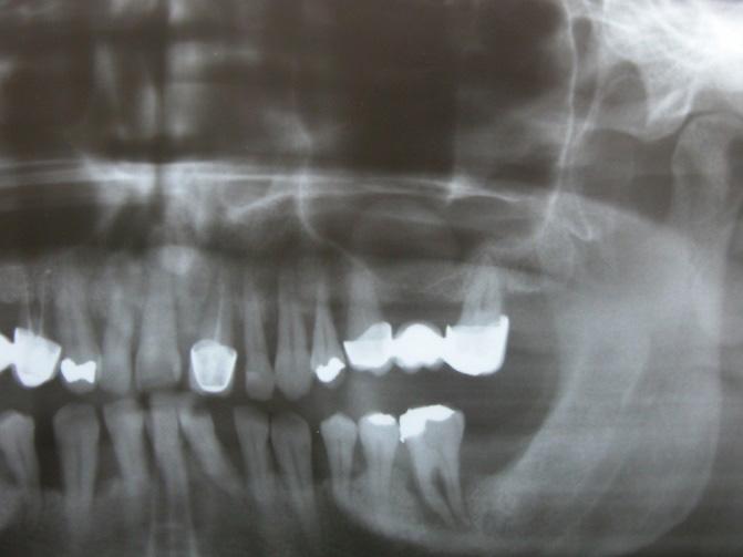 Εικ. 5.14. Βλεννοκύστη αριστερού ιγμορείου. Τα ιγμόρεια συχνά καταλαμβάνονται από κυστικές βλάβες οδοντογενείς ή μη είτε από όγκους των γνάθων (Εικ. 5.15).