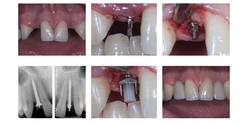 Anew Implant-supported Crowns Completed in a Single