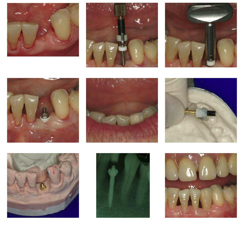 Lower Anterior Crown Replaced with Anew Implant-supported Temporary