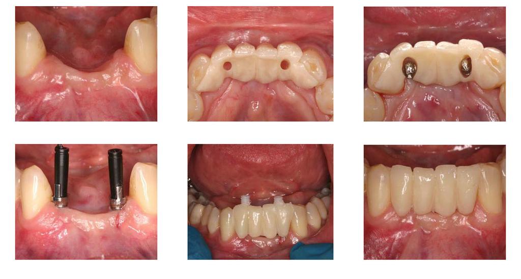 Lower Anterior Bridge supported by 2 Anew