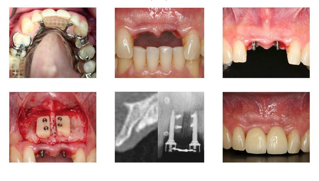 A 2-Unit Anew Implant Bridge Replacing Instantly a Partial Denture and Stabilizing a Bone Graft Courtesy of Dr.