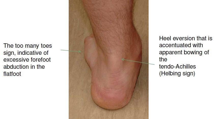 Dysfunction of Posterior Tibial