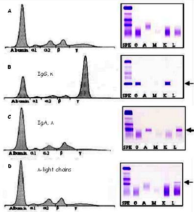 Τυποποίηση μονοκλωνικής παραπρωτεΐνης ελαφρών αλύσεων Ο κλασικός τρόπος ανίχνευσης παραπρωτεΐνης στον ορό γίνεται με SPE που δείχνει παρουσία οξυκόρυφου επάρματος και IFE που καθορίζει τον τύπο
