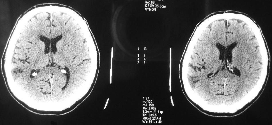 135-03 (КTM: Инфaркт мозга предње кортикалне граничне области са леве стране) Прилог 2.
