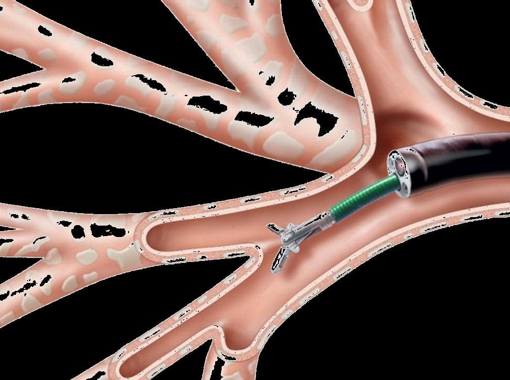 πρωτοπαθούς δυσκινησίας κροσσών Λαβίδα 1.8 mm ή 1.