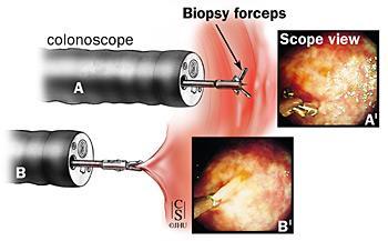 Εύκαμπτο Ενδοσκόπιο Το ενδοσκόπιο Επίσης, υπάρχει κανάλι μέσω του οποίου οι χειρουργοί μπορούν να χειριστούν μικροσκοπικά εργαλεία, Μια