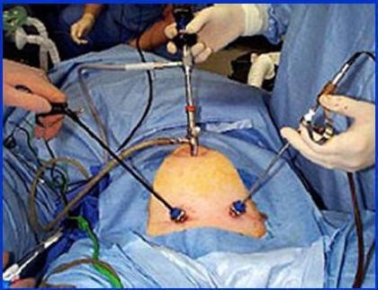 Λαπαροσκοπική Χειρουργική Μια χειρουργική επέμβαση με ελάχιστη πρόσβαση Εκτέλεση των χειρουργικών θεραπευτικών διαδικασιών μέσω μικρών