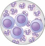 τα ακανθολυτικά κύτταρα είναι εμπύρηνα κερατινοκύτταρα από την ακανθώδη στοιβάδα που έχουν αποκολληθεί από την επιδερμίδα και εμφανίζονται στρογγυλοποιημένα.