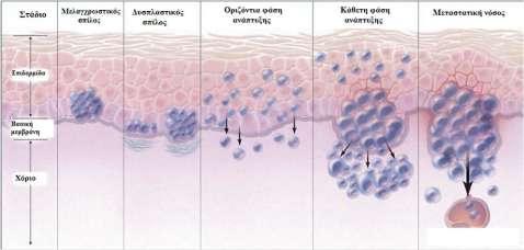 ΧΕΙΡΟΥΡΓΙΚΗ ΑΝΤΙΜΕΤΩΠΙΣΗ ΤΟΥ ΚΑΚΟΗΘΟΥΣ ΜΕΛΑΝΩΜΑΤΟΣ 1.Εισαγωγή Τα μελανοκύτταρα προέρχονται από τους μελανοβλάστες, οι οποίοι ανιχνεύονται από τον 3ο μήνα της ενδομήτριας ζωής.